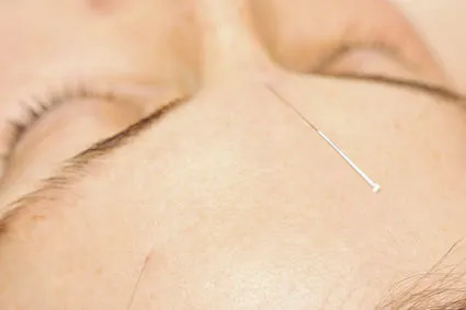 accupuncture treatment