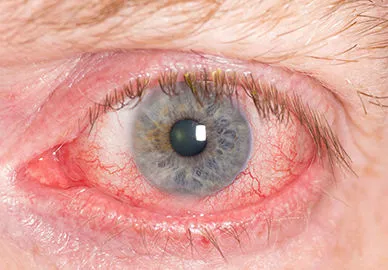 #1 Worst Oil That Promotes Blindness